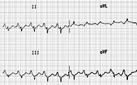 P Wave Abnormalities | Cardiology Today